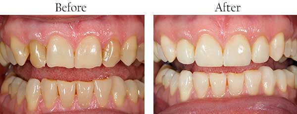 Before and After Invisalign in Streamwood