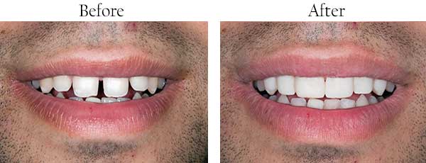 Before and After Dental Implants in Streamwood