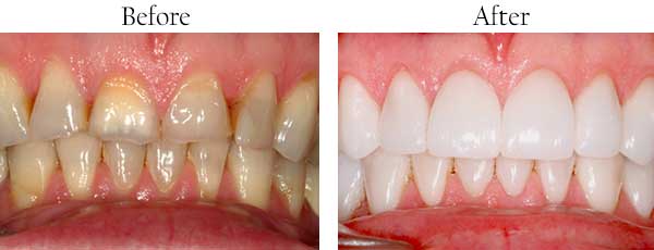 Streamwood Before and After Dental Implants
