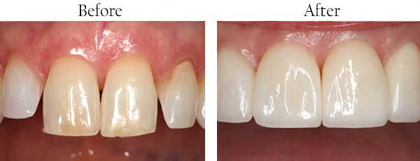 Streamwood Before and After Dental Bleaching