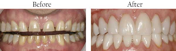 Before and After Dental Bleaching in Streamwood