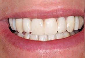 The image shows a close-up of a person s teeth and smile, highlighting the brightness and cleanliness of their dental care.