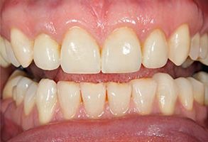The image shows a close-up of a person s teeth with a focus on the upper teeth, which are yellowed and appear to be in need of dental care.