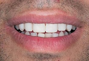 An image of a person s face with a smile, showcasing their teeth and facial features.