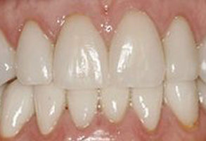 The image shows a close-up of a person s teeth with a focus on the front teeth, which are yellowed and appear to be in need of dental care.