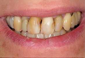 A close-up of a person s teeth showing a yellowish discoloration, with the individual smiling.