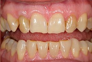 The image shows a close-up of a person s teeth with an emphasis on the yellowing and staining, which are indicative of poor oral hygiene or dental issues.