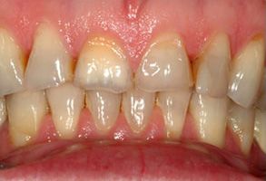 The image shows a close-up of a person s teeth with yellowing and staining, indicating poor oral hygiene.