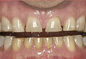 A close-up of a person s teeth with a focus on the yellowing and staining, highlighting dental issues.